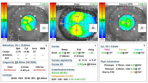 Astigmatism Diagnostic